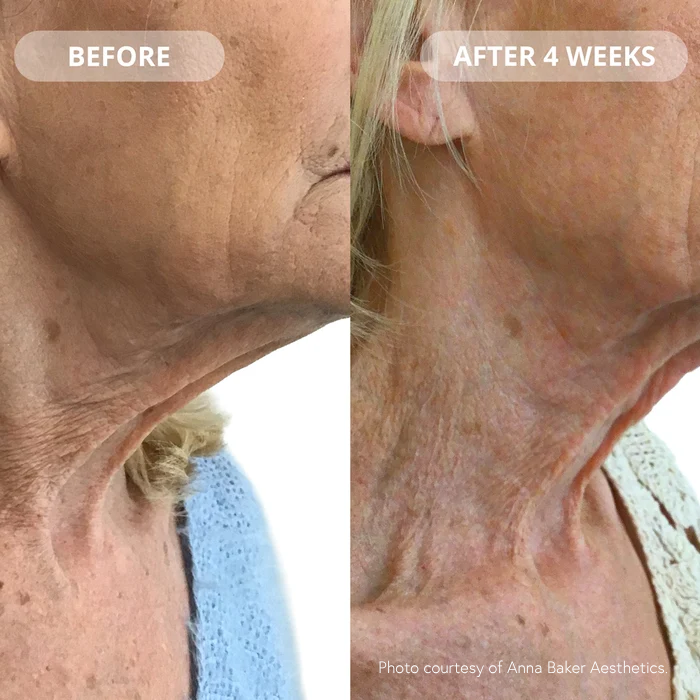 Before and after comparison of a woman's neck showing skin tightening and wrinkle reduction after 4 weeks, with text labels 'BEFORE' and 'AFTER 4 WEEKS' and a credit 'Photo courtesy of Anna Baker Aesthetics'.